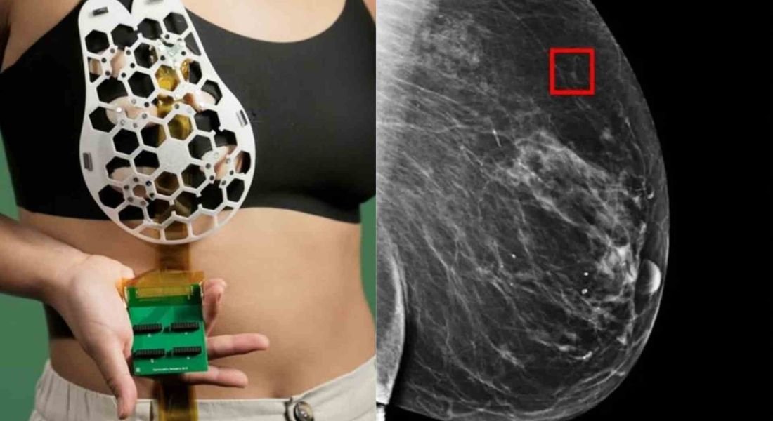 AI predicts breast cancer