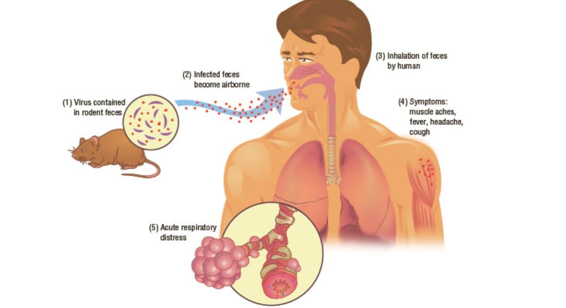 hantavirus disease